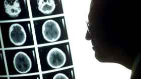 Un tac de un tumor cerebral / EFE