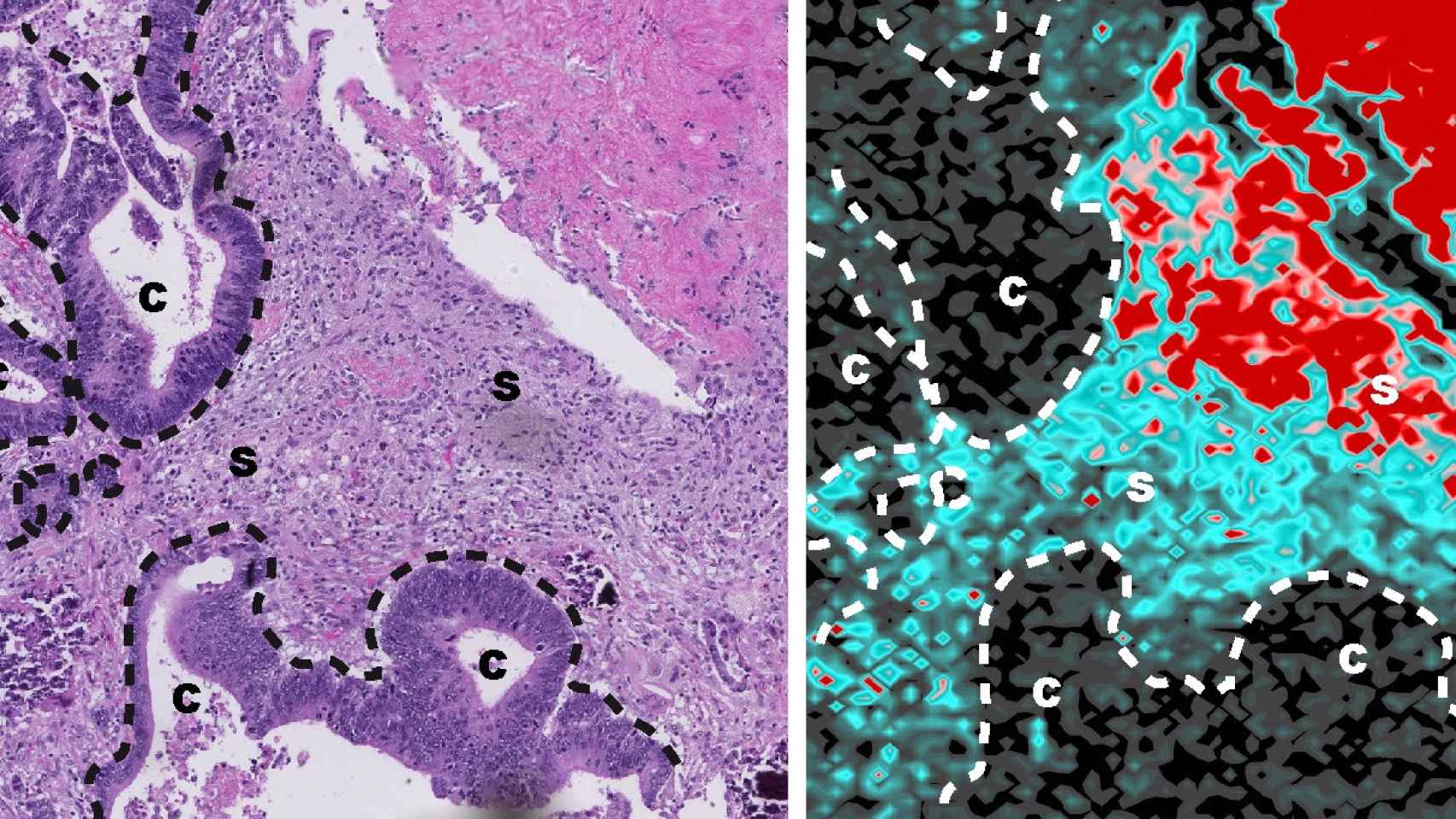 Acumulación de platino en el microambiente tumoral de un paciente con cáncer de colon 44 días después del tratamiento / IMIM