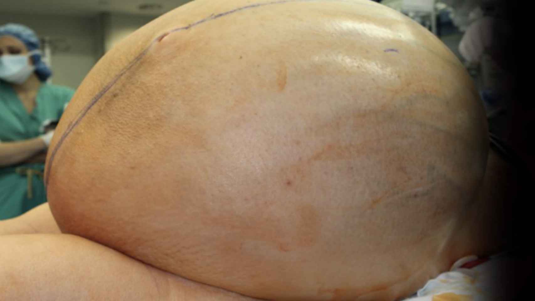 Una foto de archivo del tumor de 60 kilos de la mujer