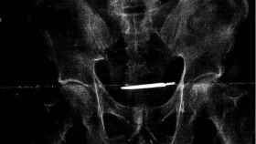 La radiografía del paciente donde se observa el bisturí