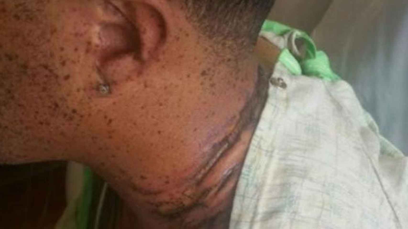 Marcas dejadas en el cuello por el collar con el que contactó el cargador del móvil