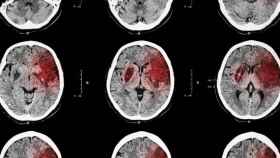 Imagen ilustrativa de una tomografía computerizada en la que se muestra un ictus / HOSPITAL SANT JOAN DE DÉU