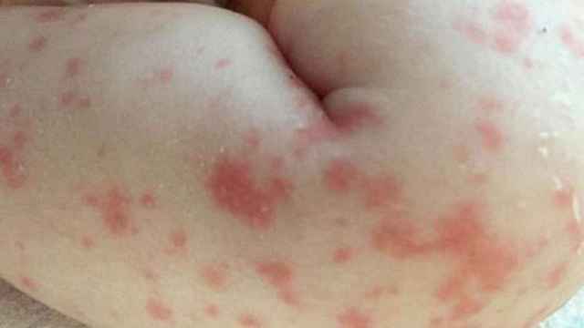 La piel del bebé reveló la infección bacteriana en su cuerpo