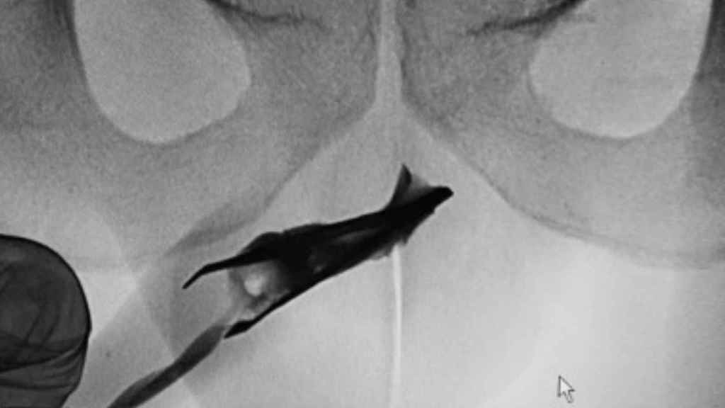 Radiografía en la que se aprecia la pinza dentro del pene y que ha quedado atrapada por un juego sexual / UROLOGY CASE REPORTS