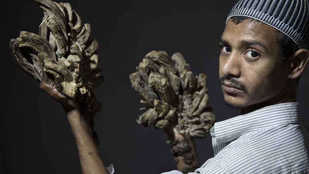 Una foto de archivo de Abul Bajandar, conocido como el 'hombre árbol'