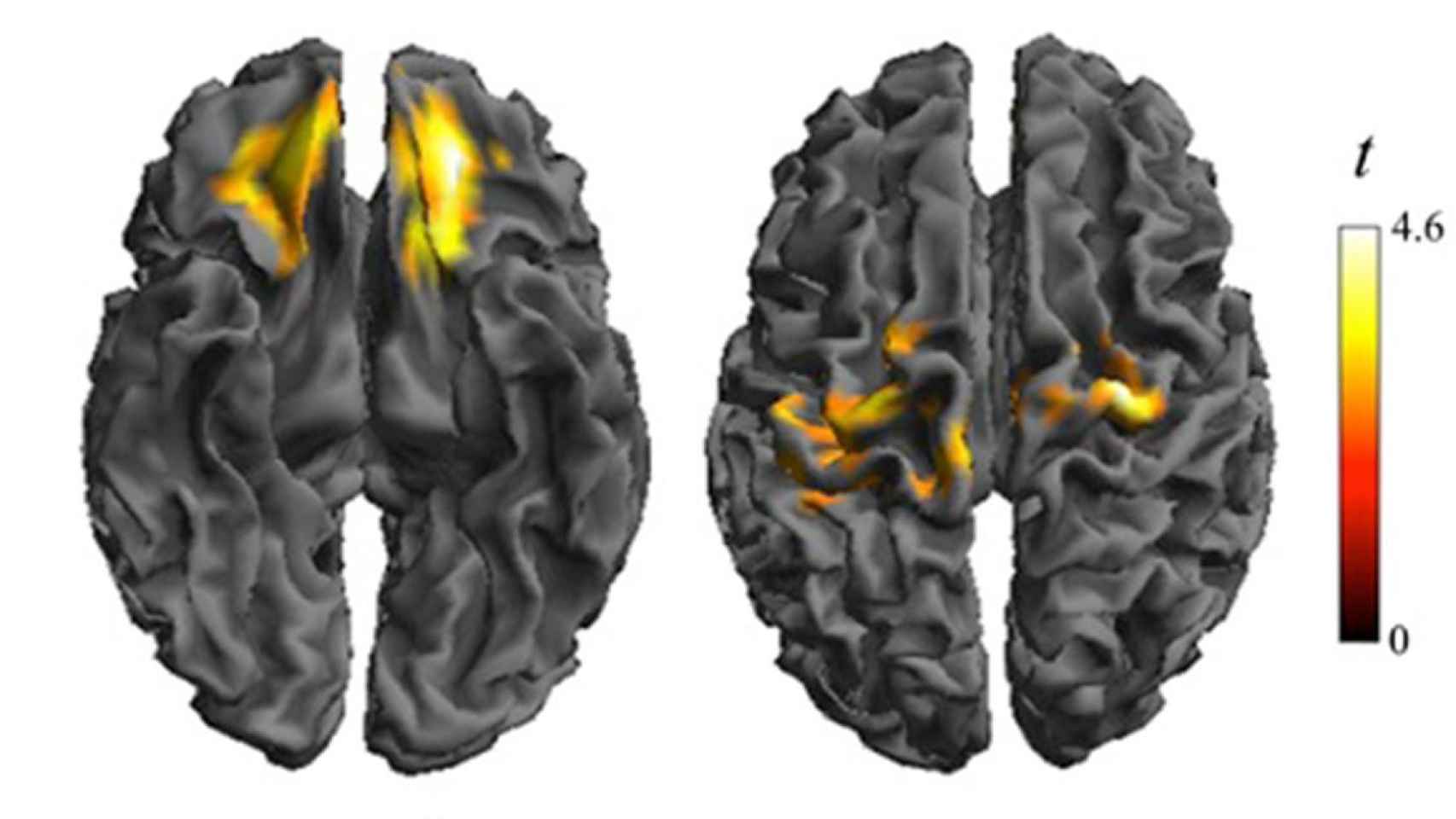 Análisis del cerebro para encontrar la relación entre la obesidad y el trastorno obsesivo-compulsivo