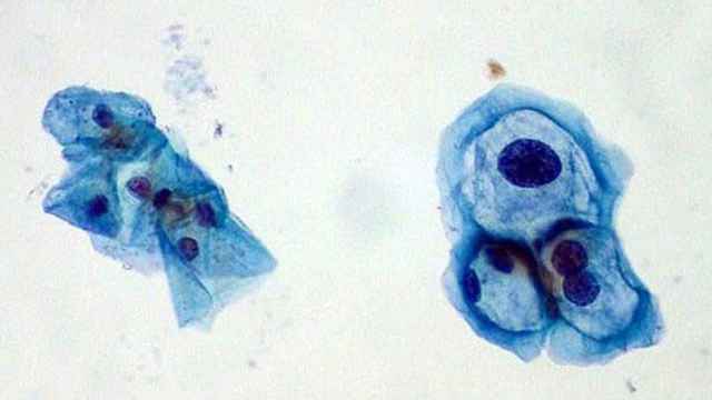 Virus del papiloma humano, la ETS de la que serán también vacunados los hombres / FLICKR - ED UTHMAN