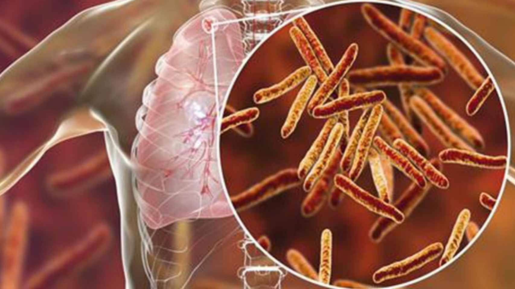 Genes causantes de la tuberculosis / EP