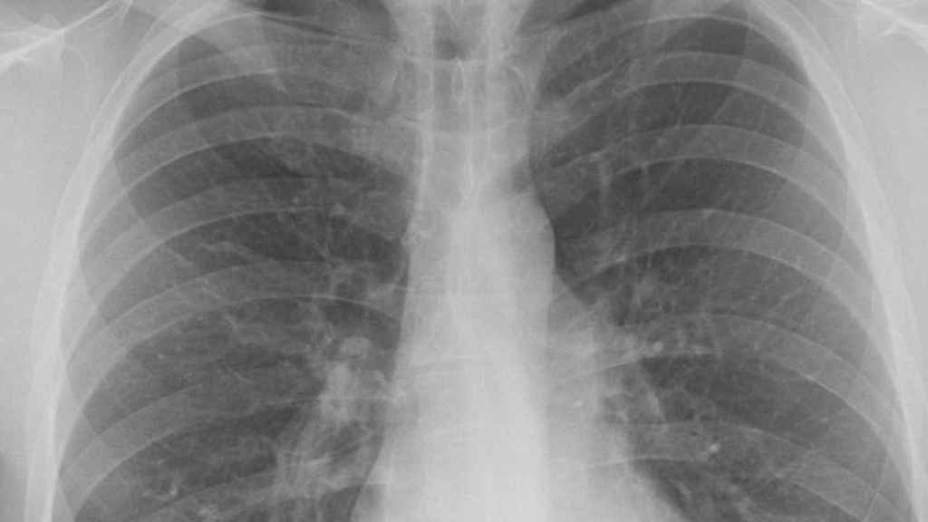 Radiografía de unos pulmones