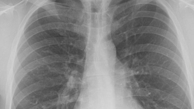 Radiografía de unos pulmones