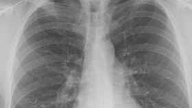 Radiografía de unos pulmones