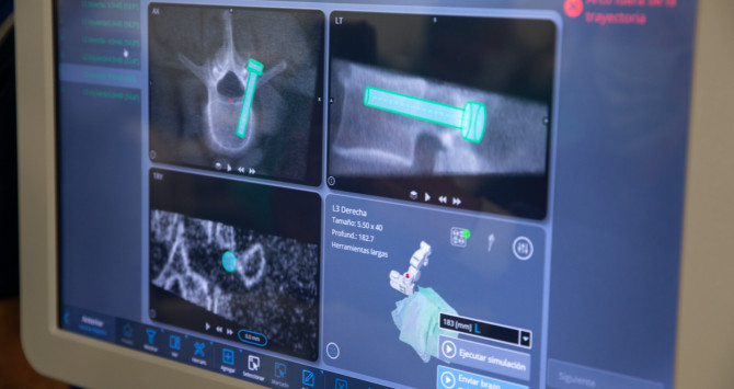 Imagen de la tecnología usada con el robot guiado / QUIRÓNSALUD