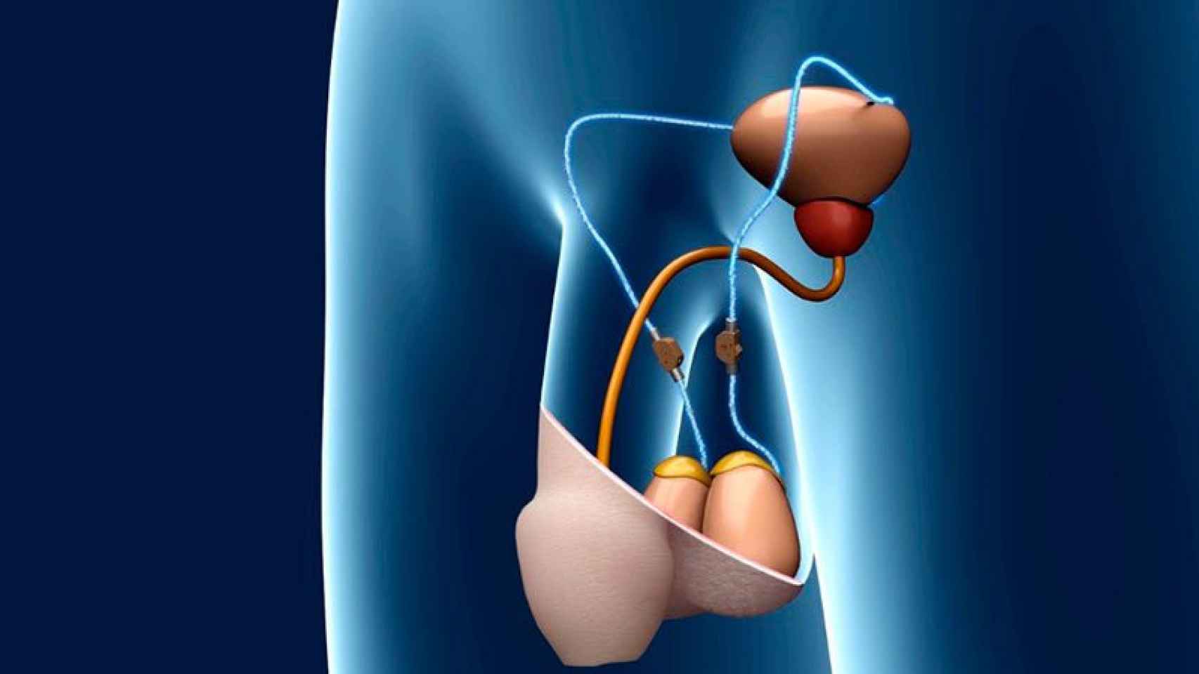 El nuevo sistema se implanta sobre los testículos y cortocircuita el tránsito de espermatozoides.