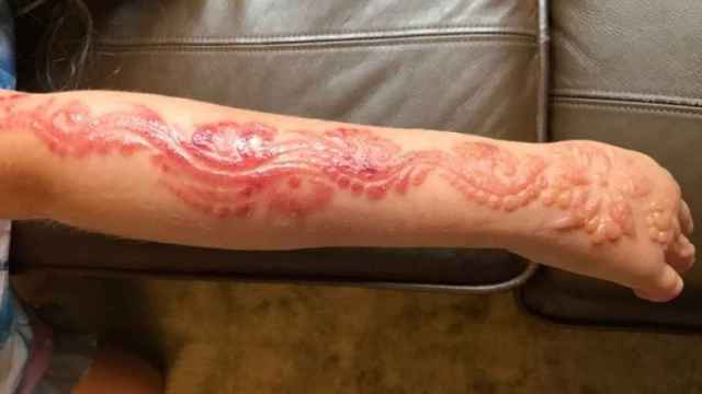 Las quemaduras de la pequeña tras hacerse el tatuaje de henna
