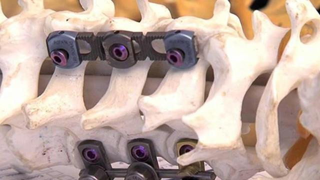 Cirugía de la columna vertebral; un paciente será indemnizado por una mala operación