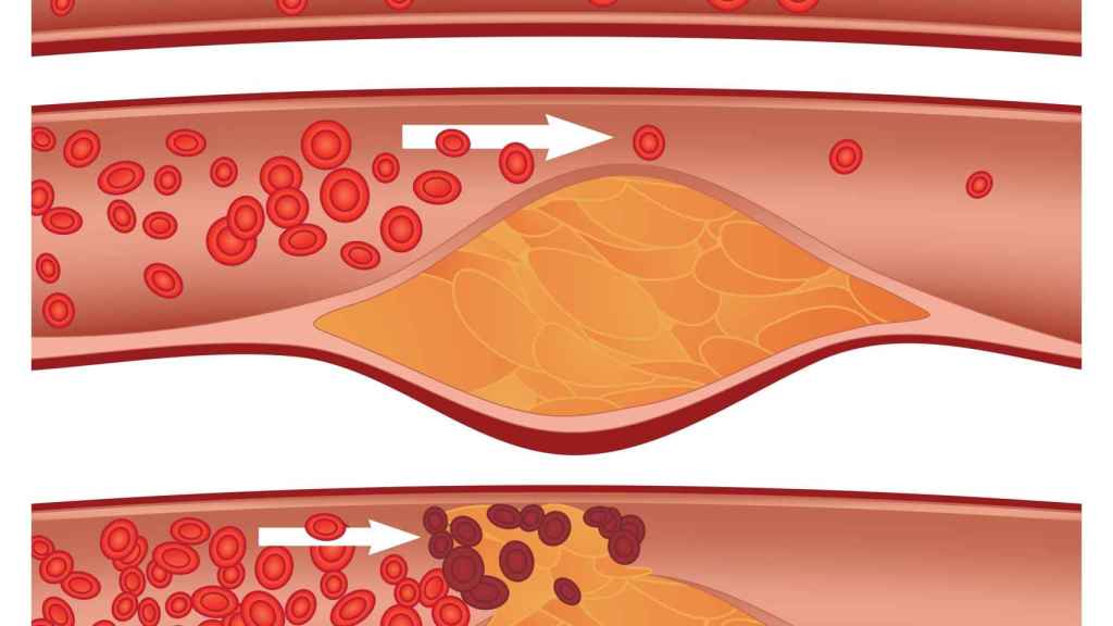 Obstruccion arterial por colesterol