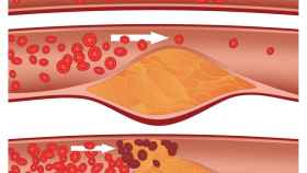 Obstruccion arterial por colesterol