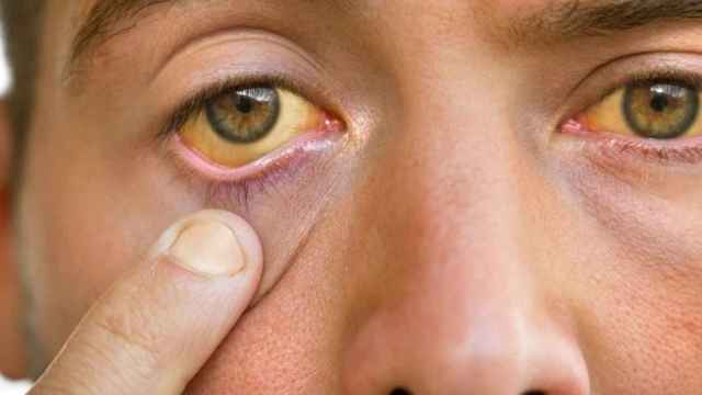 La tonalidad amarillenta del ojo indica que hay algún problema de salud / QUIRÓNSALUD