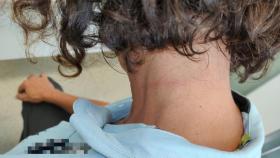 Imagen del cuello de la víctima con las marcas tras el  intento de asfixia