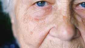 Las cataratas son un problema ocular que todava es la causa ms comn de prdida de visin en personas mayores de 40 aos. /ANNA SHVETS