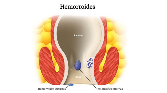 tipos hemorroides