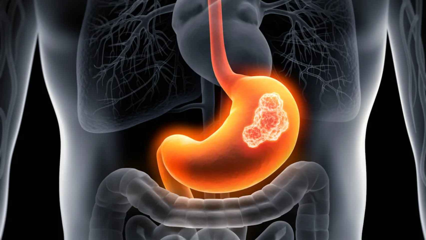 La acalasia es un trastorno del aparato digestivo