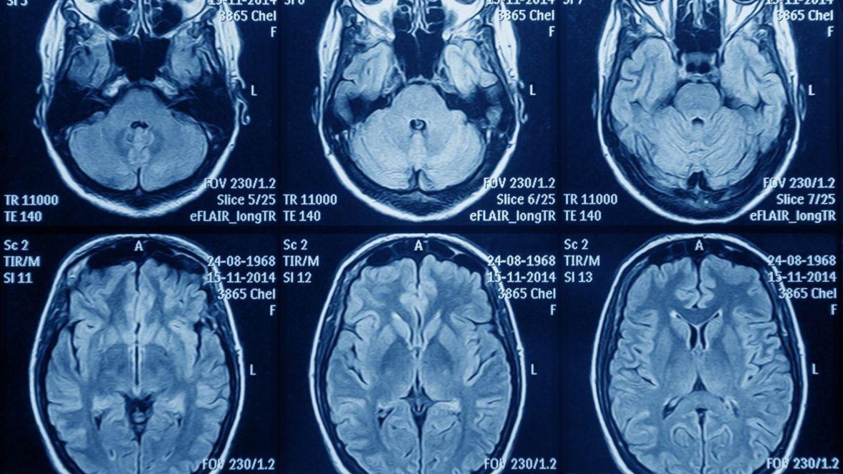 Resonancia magnética del cerebro