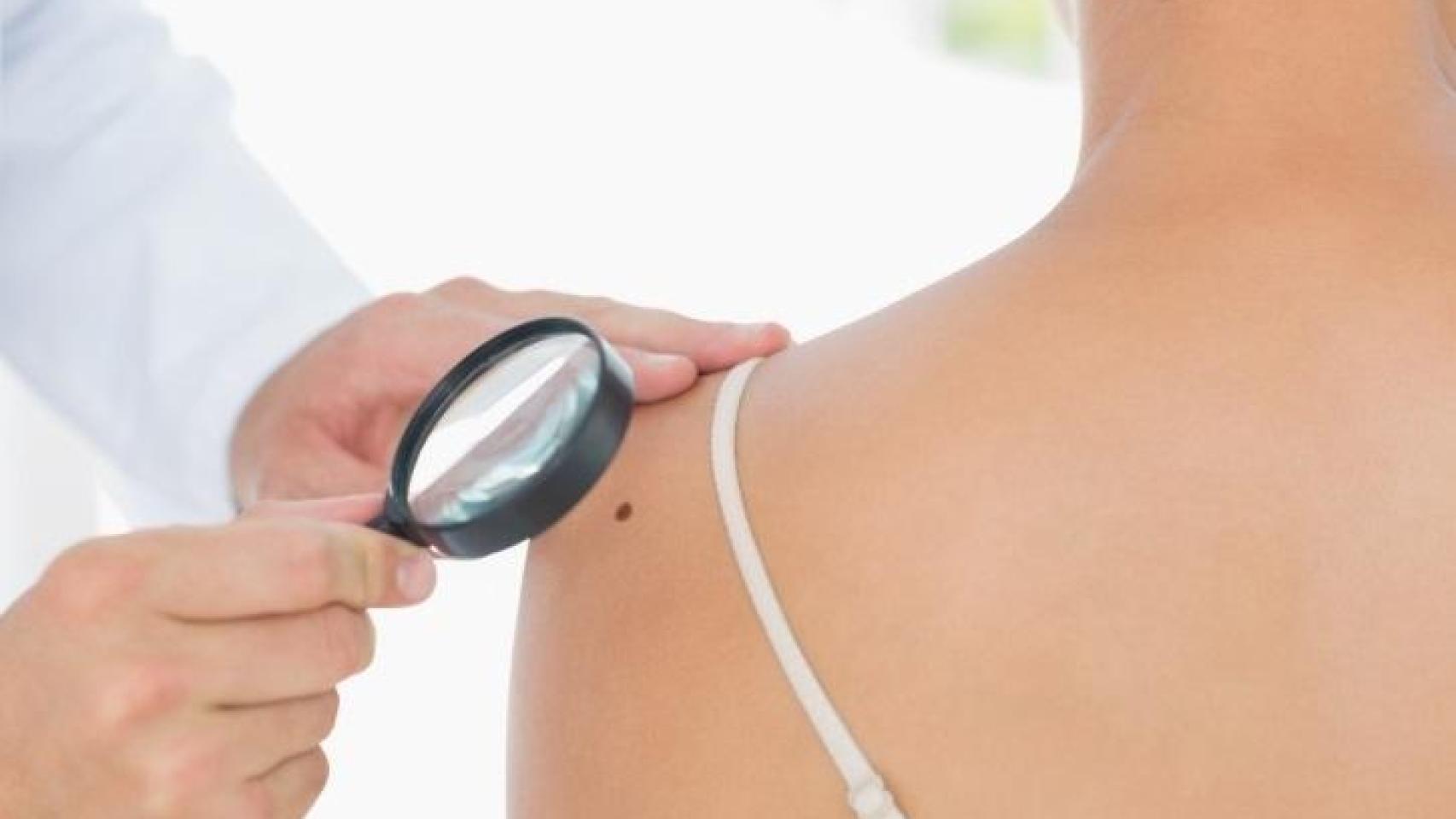 Un dermatólogo inspecciona el lunar en el hombro de una joven