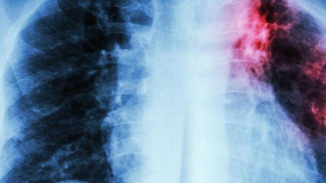 Fibrosis Pulmonar IStock