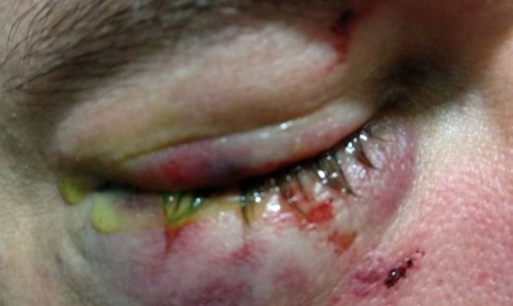 Ojo herido por una pedrada del agente de la Guàrdia Urbana.