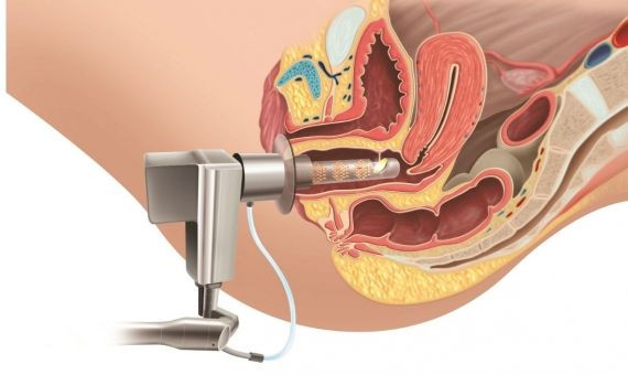 Así actúa el láser ginecológico por vía vaginal / QS