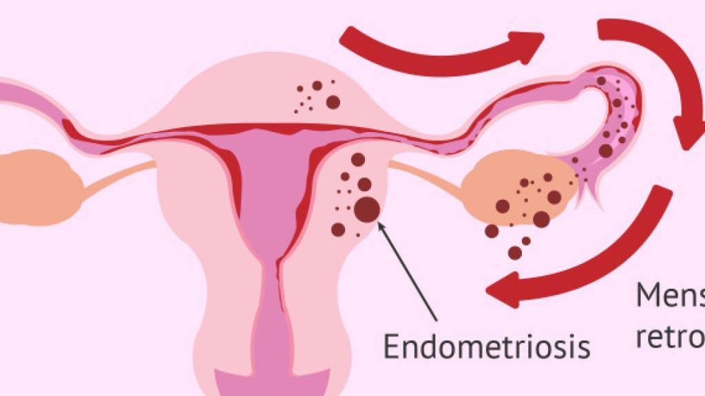 A veces, el endometrio crece fuera del útero, principalmente en los ovarios