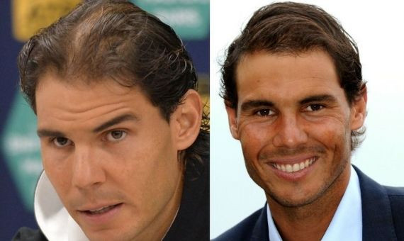 Rafa Nadal antes y después