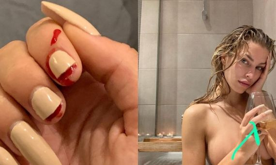 Uñas rotas de Jessica Goicoechea tras la supuesta paliza recibida por parte de River Viiperi / METRÓPOLI ABIERTA