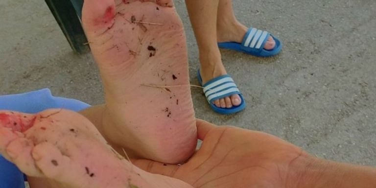 Los pies heridos de un niño en la Creueta del Coll / betevé