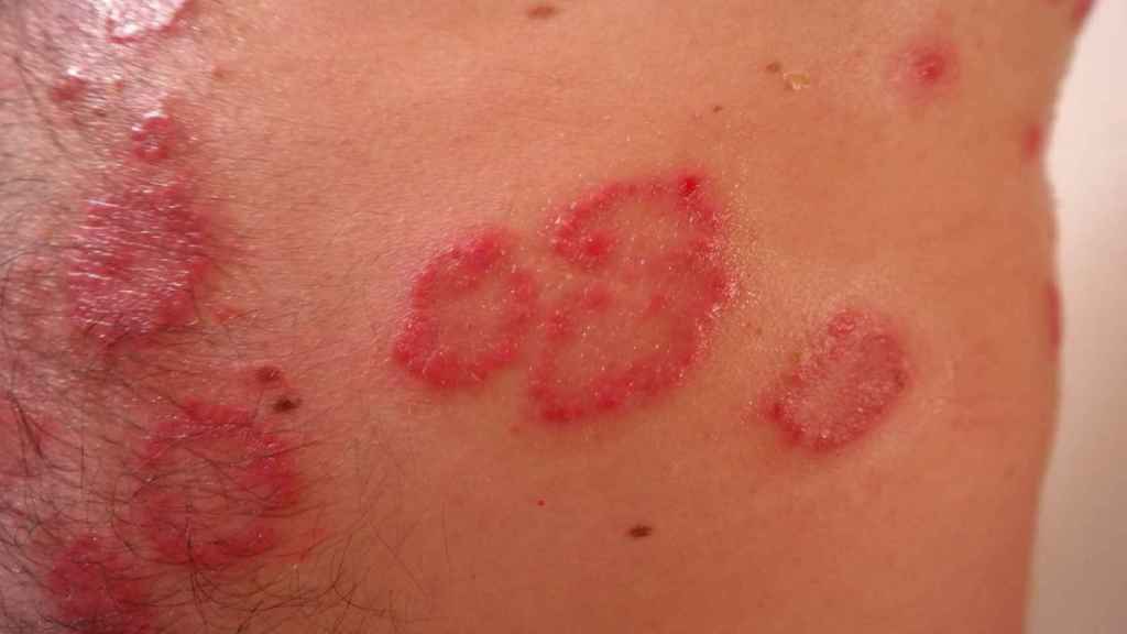 Síntomas típicos de la psoriasis / ARCHIVO