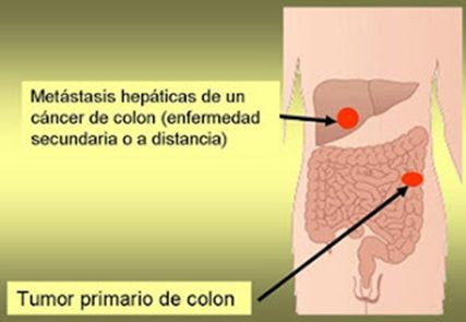 Gráfico de una metástasis hepática / QUIRÓNSALUD