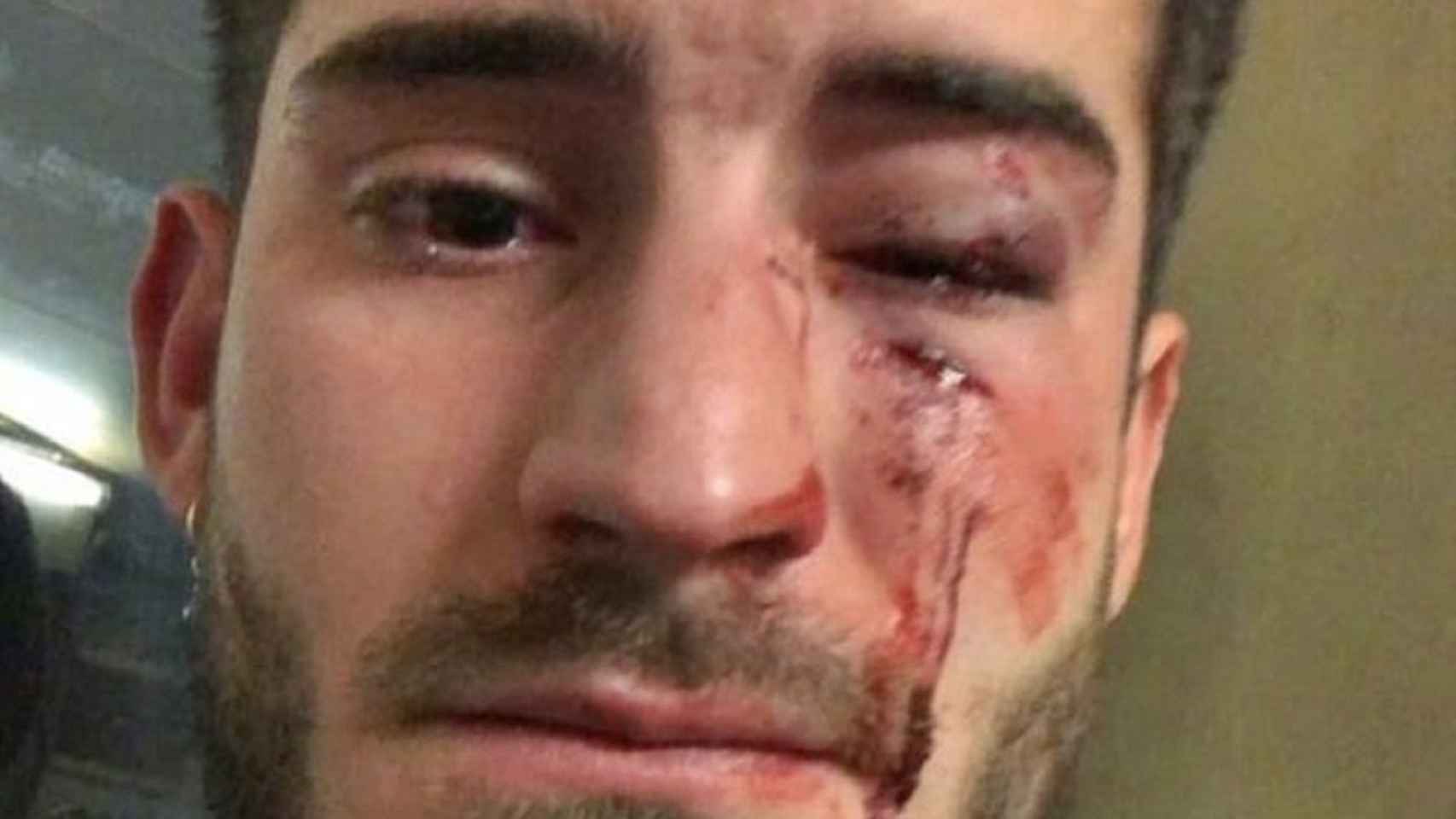 La víctima, Diego Martos, momentos después de la agresión homófoba en 2019 / INSTAGRAM