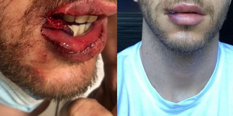 Antes y después de que le cosieran el labio a Víctor / RRSS