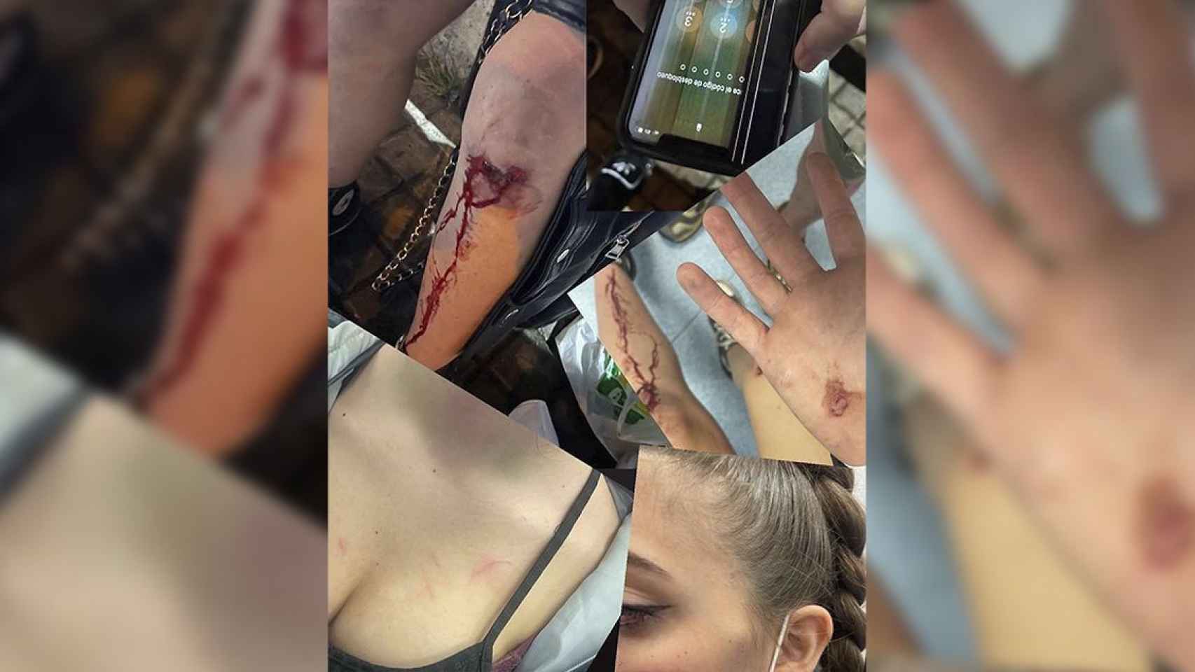 Heridas de la joven que sufrió la agresión en Waka Sabadell / INSTAGRAM