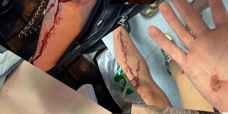 Heridas de la joven que sufrió la agresión en Waka Sabadell / INSTAGRAM