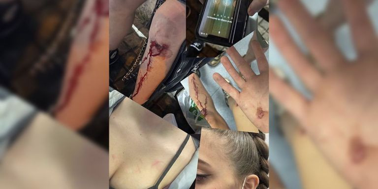 Heridas de la joven que sufrió la agresión en Waka Sabadell / INSTAGRAM