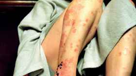 La psoriasis es una enfermedad crónica de la piel cuyos síntomas son muy visibles / FLICKR