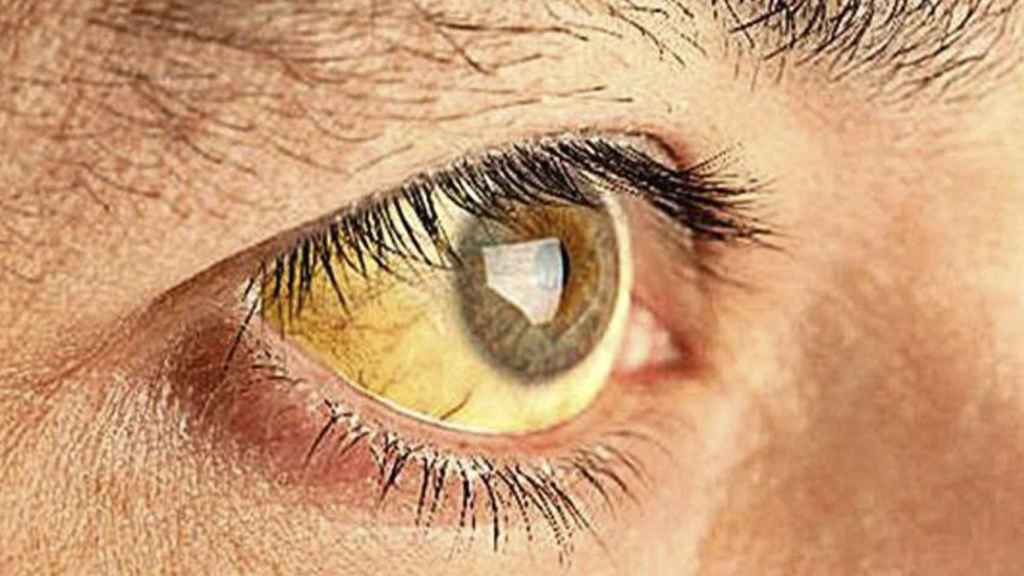 El tono amarillento de los ojos puede advertir de una enfermedad más seria / QUIRÓNSALUD