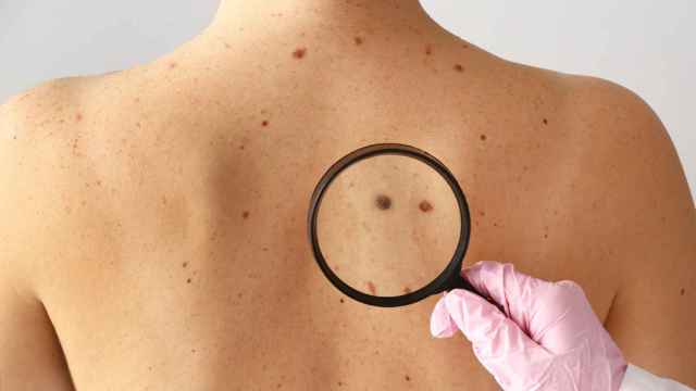 Una mujer muestra manchas en la piel de su espalda