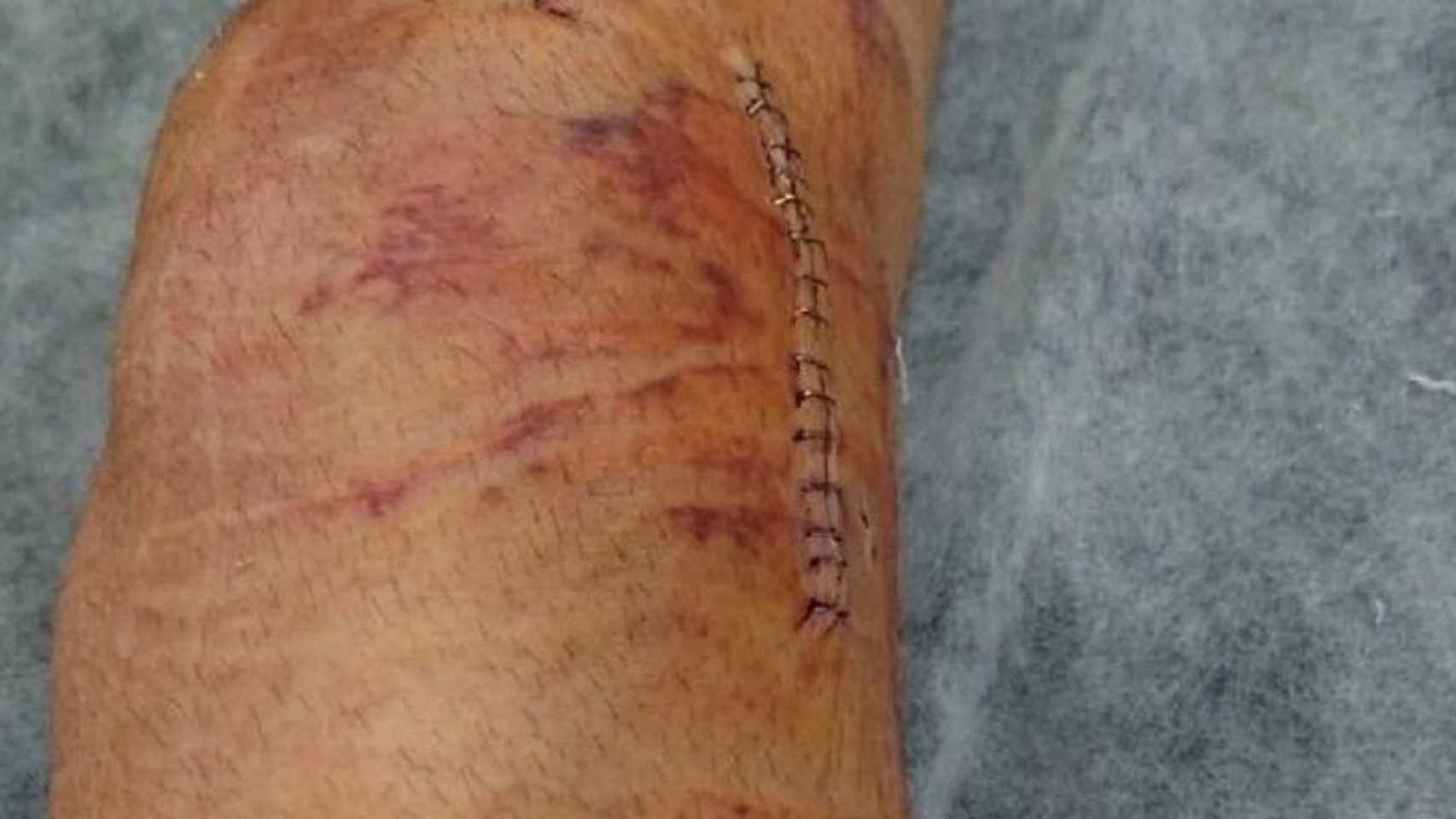 La rodilla de Albert, tras ser operado por el accidente en los cojines berlineses