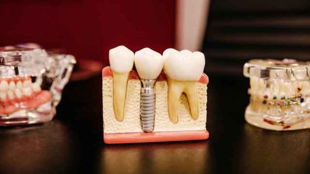 Implante dental y dentaduras postizas
