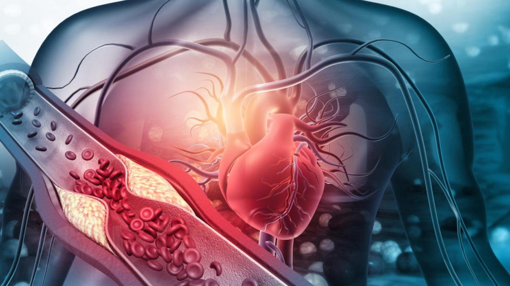 El colesterol es una de las causas directas de los accidentes cardiovasculares